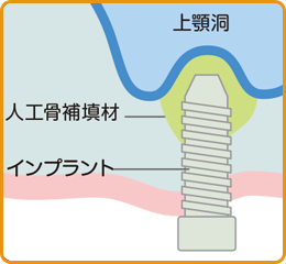 インプラント骨造成（サイナスリフト）