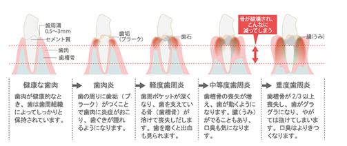 歯周病の進行