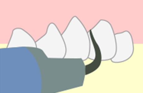 歯石の除去について
